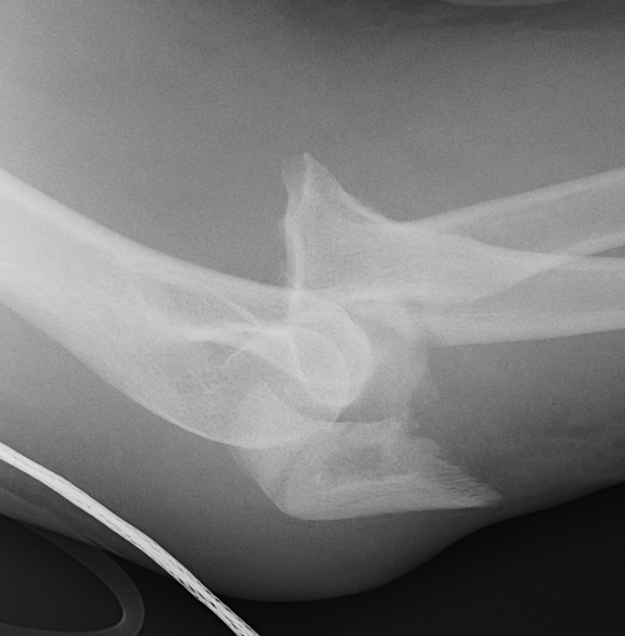 Elbow Dislocation Fracture Olecranon and Radial Head